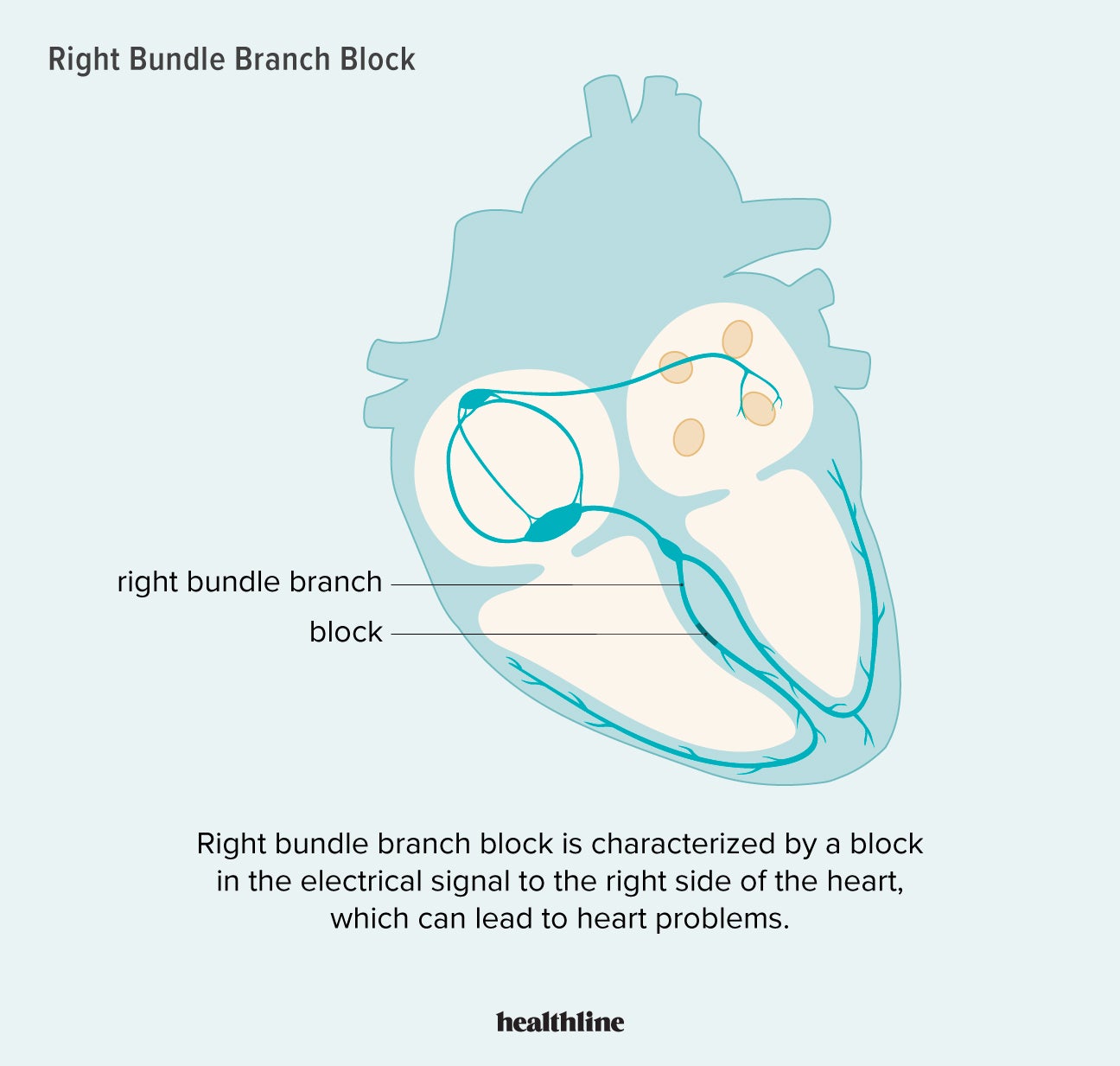 Right Bundle Branch Block Symptoms Causes Diagnosis Treatment